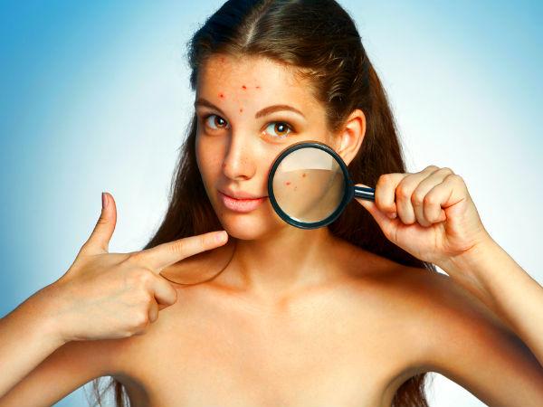 Mụn nổi trên khắp cơ thể Mụn nổi trên khắp cơ thể