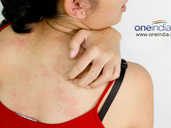 Ngứa và tê Ngứa và tê