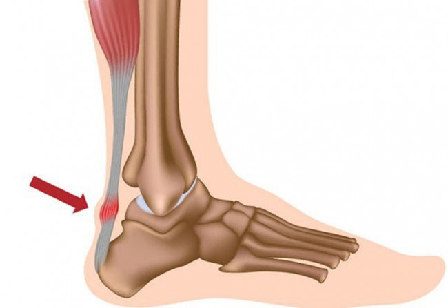 Khi mang giày cao gót thường xuyên gót chân sẽ bị tổn thương 