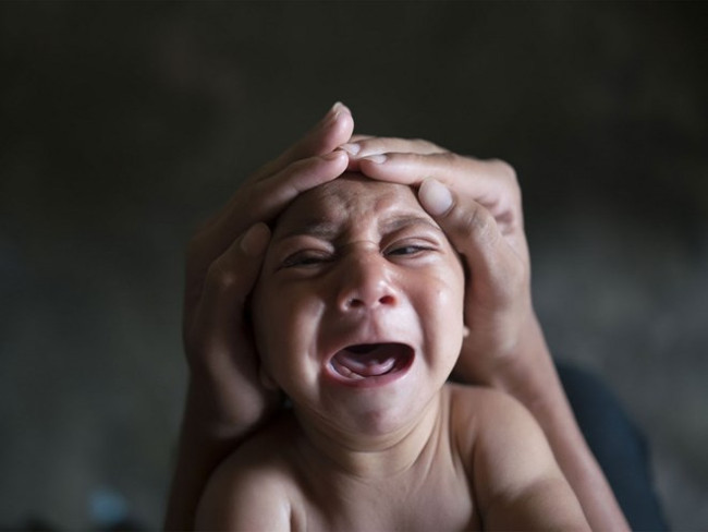 Hội chứng đầu nhỏ