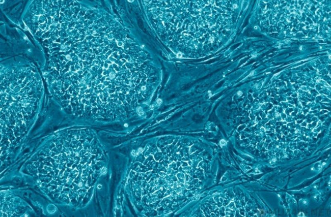 Liệu pháp điều trị đột quỵ bằng cách sử dụng tế bào gốc