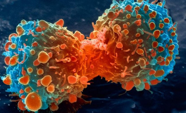 Phát hiện chậm căn bệnh ung thư mới là lý do thực sự giết chết chúng ta