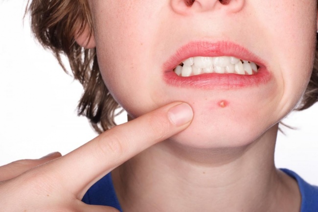 Giảm mụn trứng cá