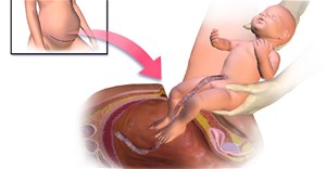 Cảnh báo: “Sinh mổ làm tăng nguy cơ béo phì cho trẻ sau này”