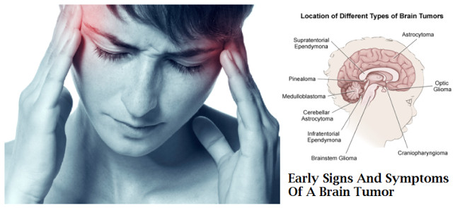 Triệu chứng của bệnh ung thư não  Triệu chứng của bệnh ung thư não