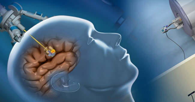 Lasers plus 'mini' craniotomy tín hiệu đáng mừng cho bệnh nhân u não Lasers plus 'mini' craniotomy tín hiệu đáng mừng cho bệnh nhân u não