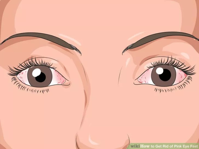 Những nguyên nhân của bệnh đau mắt đỏ