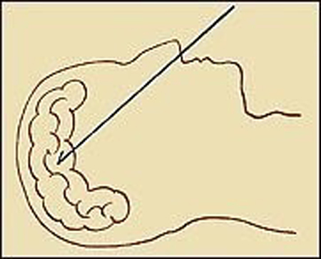 Não cũng được những người thợ ướp xác lấy ra bằng một các móc đặc biệt.