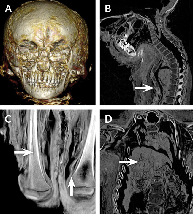 Một số hình ảnh xác ướp được ghi lại được dưới công nghệ chụp CT Scan Một số hình ảnh xác ướp được ghi lại được dưới công nghệ chụp CT Scan