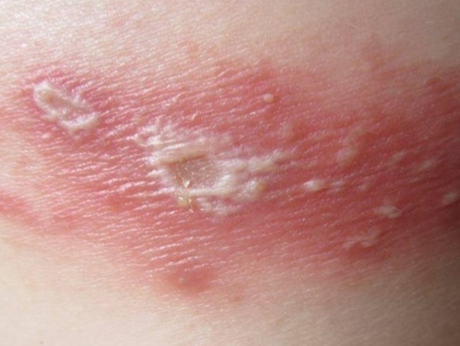 Vết đốt của kiến ba khoang Vết đốt của kiến ba khoang