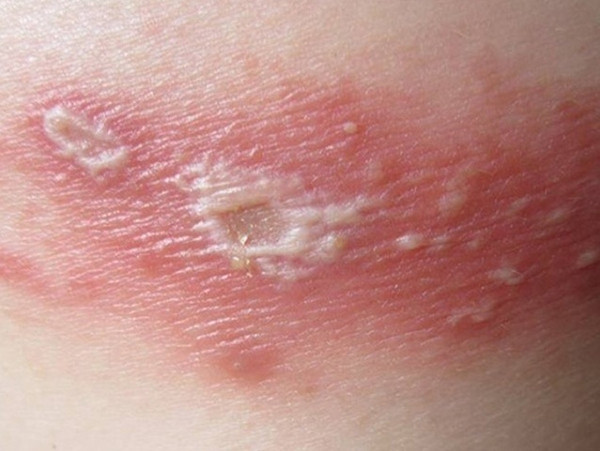 Vết đốt của kiến ba khoang 