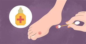 Cách chữa phồng rộp da chân khi đi bộ nhiều, mang giày chật