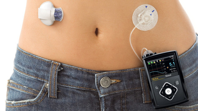 Tụy nhân tạo Minimed 670g