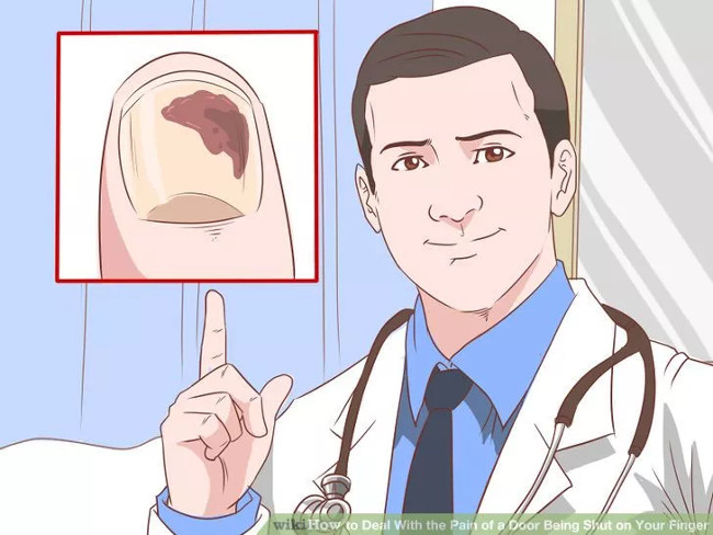 Tuân theo hướng dẫn của bác sĩ để loại bỏ lượng máu tích tụ bên dưới móng tay