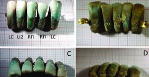 Khảo cổ Ý tìm ra bộ răng giả lâu đời nhất trên thế giới