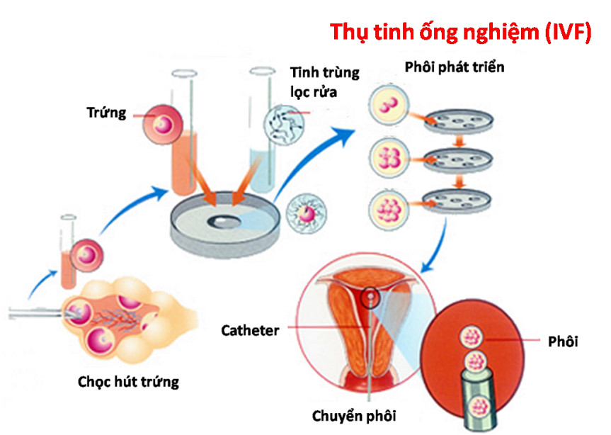 Kỹ thuật thụ tinh nhân tạo
