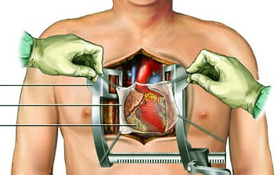 Người béo phì ít có nguy cơ tử vong sau phẫu thuật tim 