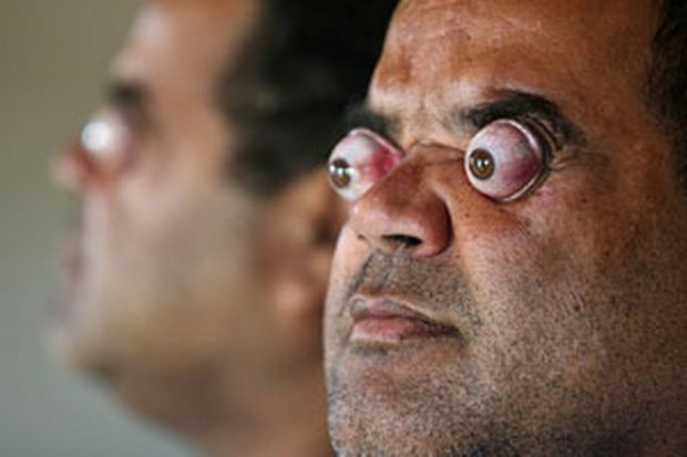 Người có đôi mắt lồi