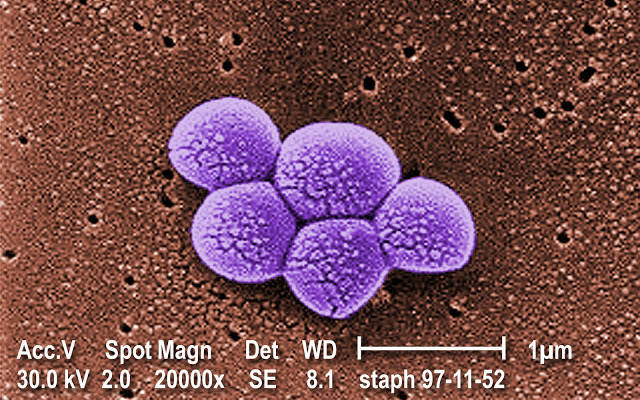 MRSA là một loại siêu vi khuẩn chết người