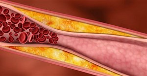 Bài thuốc giúp làm sạch mạch máu, giảm mỡ máu các gia đình nên biết