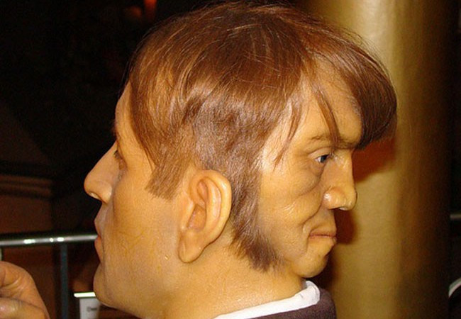 Edward Mordrake, người có hai khuôn mặt   Edward Mordrake, người có hai khuôn mặt