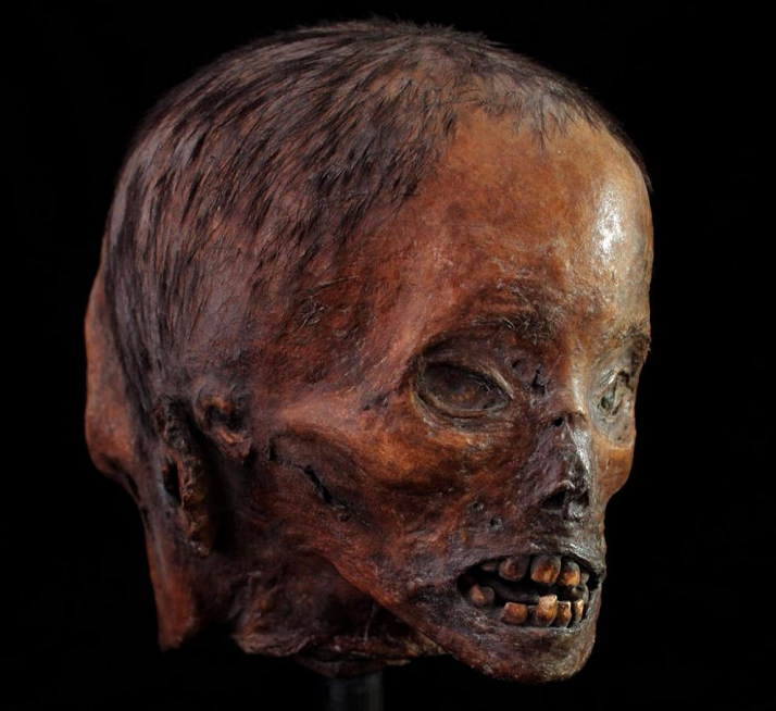 Hộp sọ của Edward Mordake được lưu giữ tại viện bảo tàng