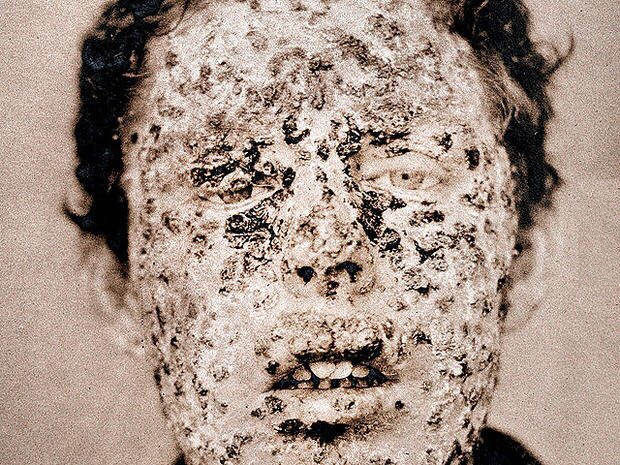 Gương mặt của một bệnh nhân mắc bệnh đậu mùa ở New York, Mỹ Gương mặt của một bệnh nhân mắc bệnh đậu mùa ở New York, Mỹ