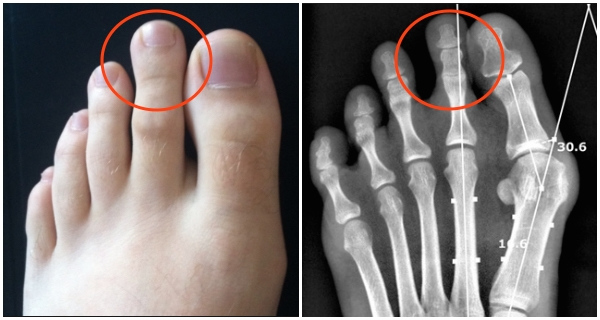 Ngón trỏ dài hơn những ngón còn lại trong bàn chân