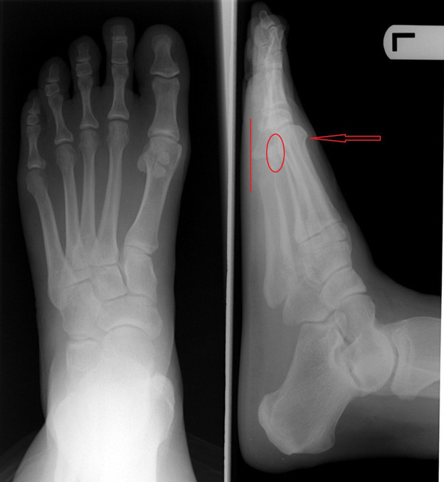 Trong ảnh chụp X-quanh, khi ngón trỏ dài hơn thì phần xương ngón chân cái cũng bị ép và cong sát vào với nó.