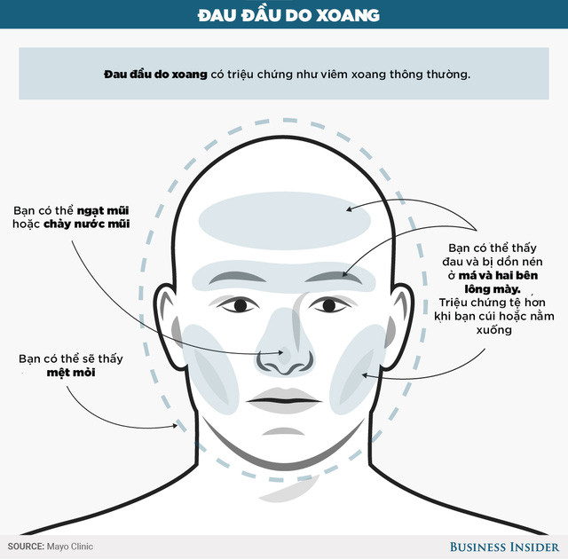 Đau đầu do viêm xoang