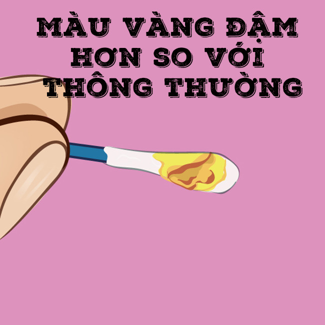 Ráy tai đột nhiên có màu đậm hơn so với thông thường
