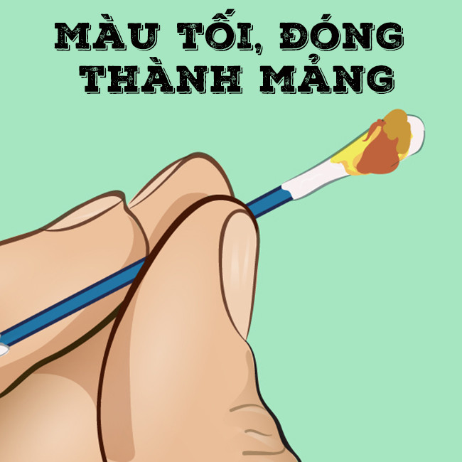 Ráy tai màu tối, đóng thành các mảng dày