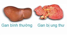Muốn phòng tránh ung thư gan, chỉ cần làm tốt 3 việc sau