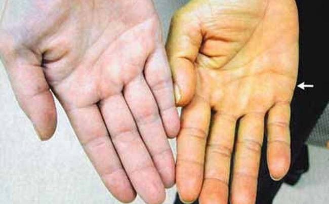 Triệu chứng của bệnh gan 