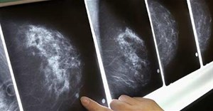 Tìm ra phương pháp mới để điều trị ung thư vú