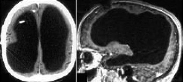Hình ảnh chụp não của người đàn ông kỳ lạ với phần não nhỏ đến độ gần như không có