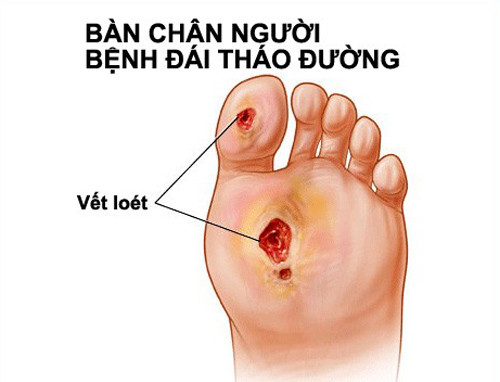 Vết thương lâu lành lại