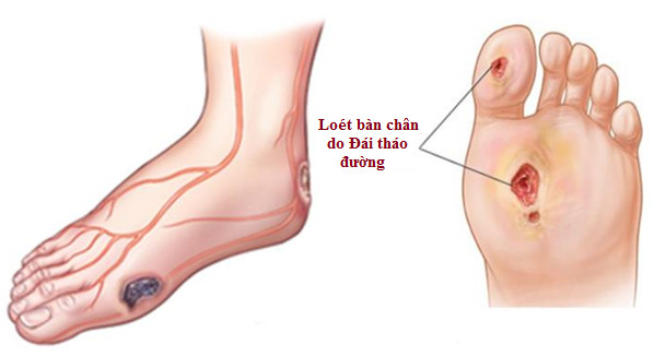 Loét lâu lành ở dưới lòng bàn chân