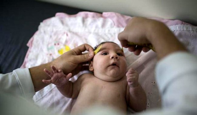 Virus Zika thường gây ra dị tật bẩm sinh nghiêm trọng ở bào thai Virus Zika thường gây ra dị tật bẩm sinh nghiêm trọng ở bào thai