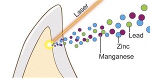 Liên kết giữa chứng tự kỷ và mức độ chì độc hại tìm thấy trong răng trẻ