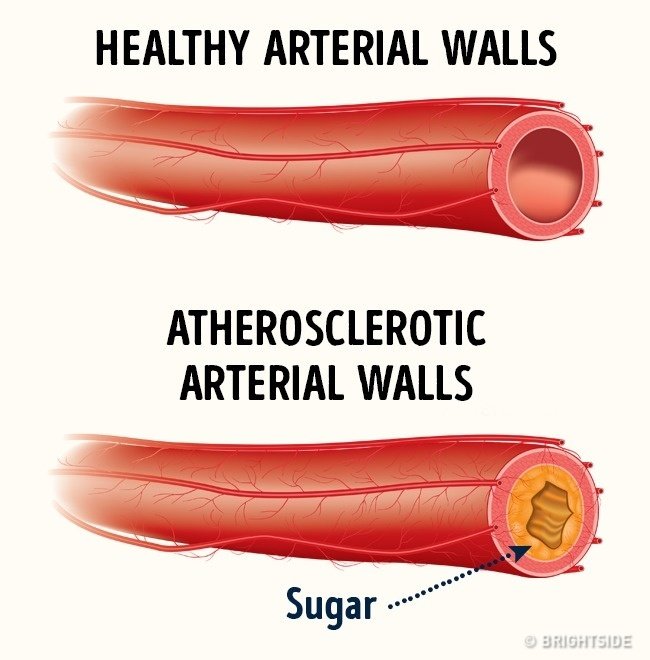 Đường gây ra bệnh tim mạch