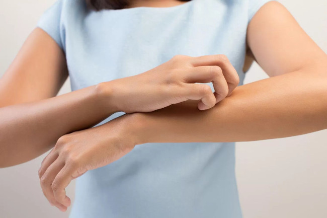 Bệnh chàm và bệnh tim có mối liên hệ lẫn nhau