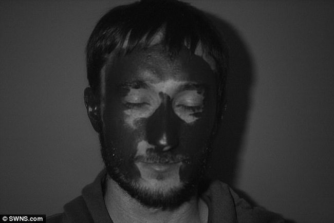 Điều đáng cảnh báo ở đây là hơn 90% ca ung thư biểu mô tế bào đáy (basal cell carcinomas) - loại ung thư da phổ biến nhất ở Anh xuất hiện ở phần cổ và đầu; 5 - 10% ca ung thư da còn lại đều xuất hiện trên mí mắt.