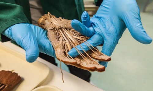 Một bàn tay người hiến xác được bảo quản trong hóa chất từ những năm 1980