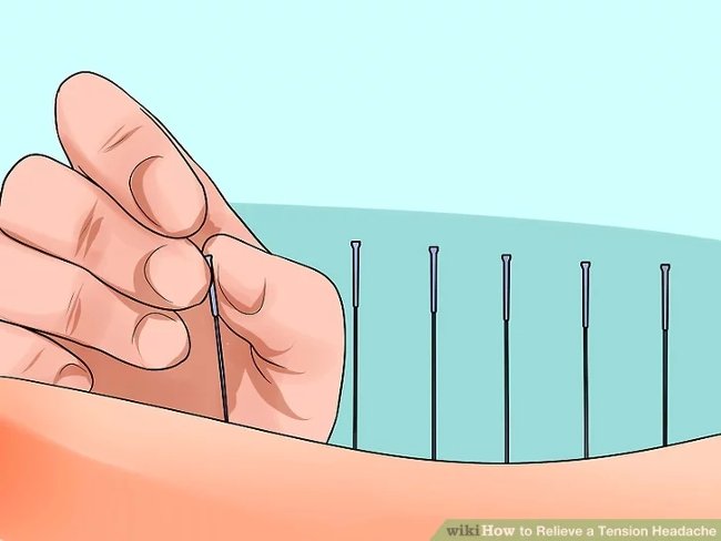 Thử dùng liệu pháp châm cứu