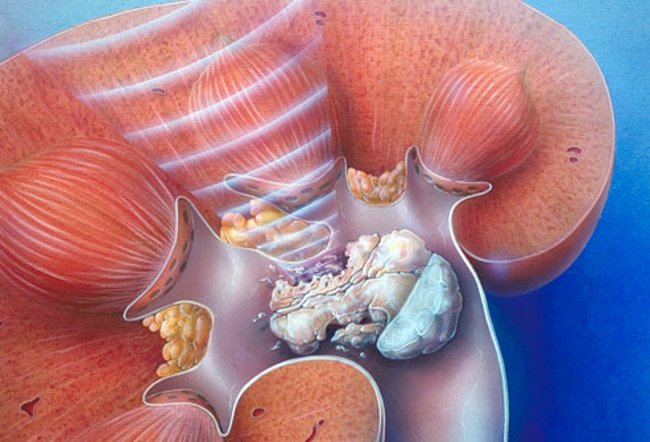 Ngăn ngừa sỏi thận