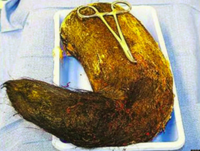 Tại một bệnh viện ở Mỹ, các bác sĩ đã phẫu thuật cho một bệnh nhân nữ bị đau bao tử và lấy ra một búi lông tóc nặng gần 5kg