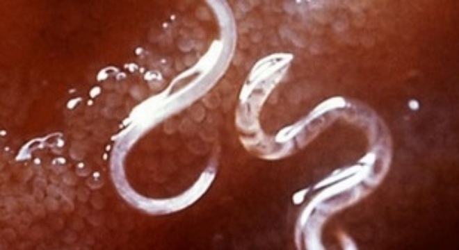 Giun sán có thể chui vào não con người 