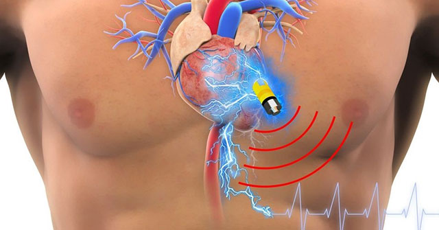 Bệnh nhân sử dụng máy điều hòa nhịp tim được khuyến cáo đi gặp bác sĩ