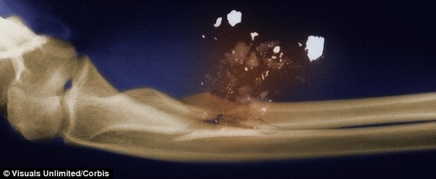 Viên đạn va vào xương và đổi hướng ngay trong cơ thể